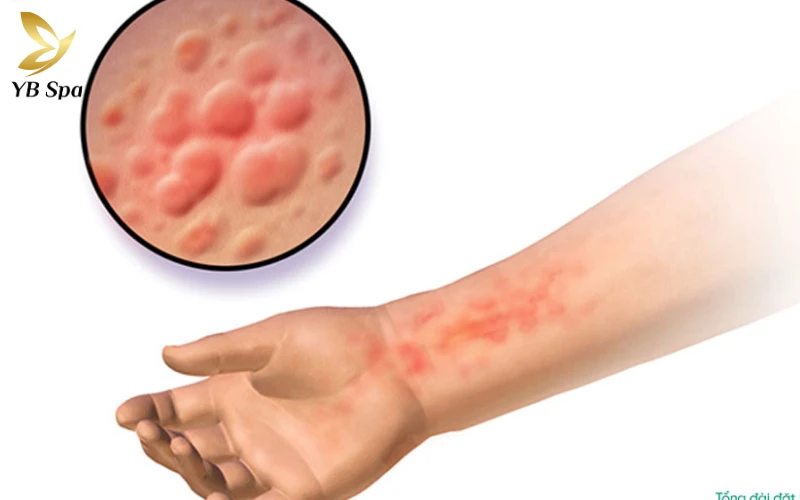 Da bị ngứa gãi nổi hột là gì? Có nguy hiểm không? 25 Tình trạng da bị ngứa gãi nổi hột là gì?