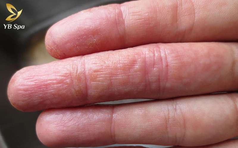 Da bị ngứa gãi nổi hột là gì? Có nguy hiểm không? 26 Bệnh tổ đỉa (Dyshidrosis)