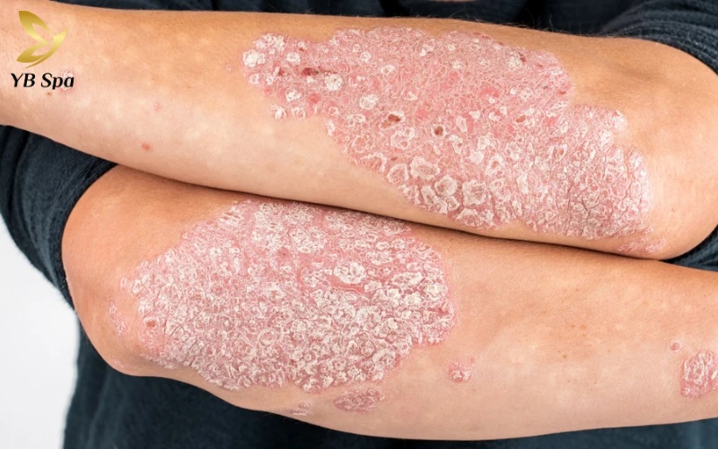 Da bị ngứa gãi nổi hột là gì? Có nguy hiểm không? 27 Vảy nến (Psoriasis)