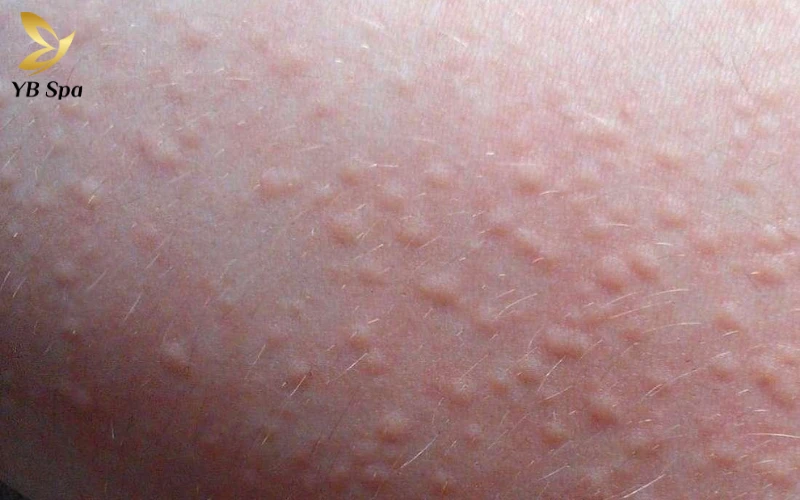 Da bị ngứa gãi nổi hột là gì? Có nguy hiểm không? 28 Mề đay (Urticaria)