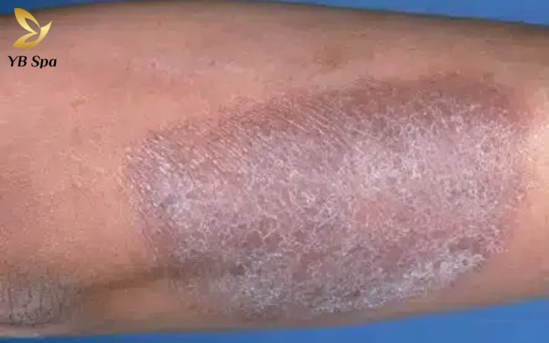 Da bị ngứa gãi nổi hột là gì? Có nguy hiểm không? 31 Nguy cơ viêm nhiễm và tổn thương cấu trúc da