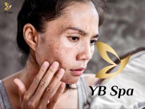 Da bị tăng sắc tố sau Peel? Nguyên nhân và cách điều trị