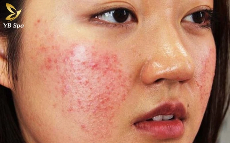 Da Mặt Bị Nẻ Mẩn Đỏ