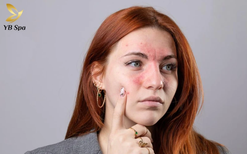 Da mặt bị ngứa sần sùi phải làm sao? 22 Da mặt bị ngứa sần sùi phải làm sao?