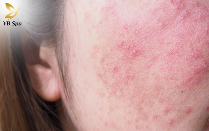 Nguyên nhân từ sản phẩm chăm sóc da khiến da mặt bị ngứa sần sùi