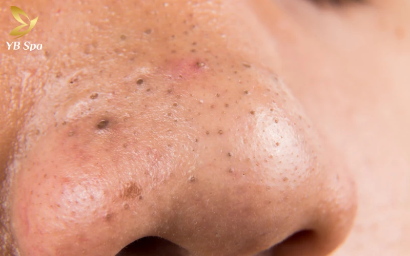 Da mặt đột nhiên nổi nhiều mụn - Nguyên nhân và giải pháp điều trị 29 Nhóm mụn không viêm