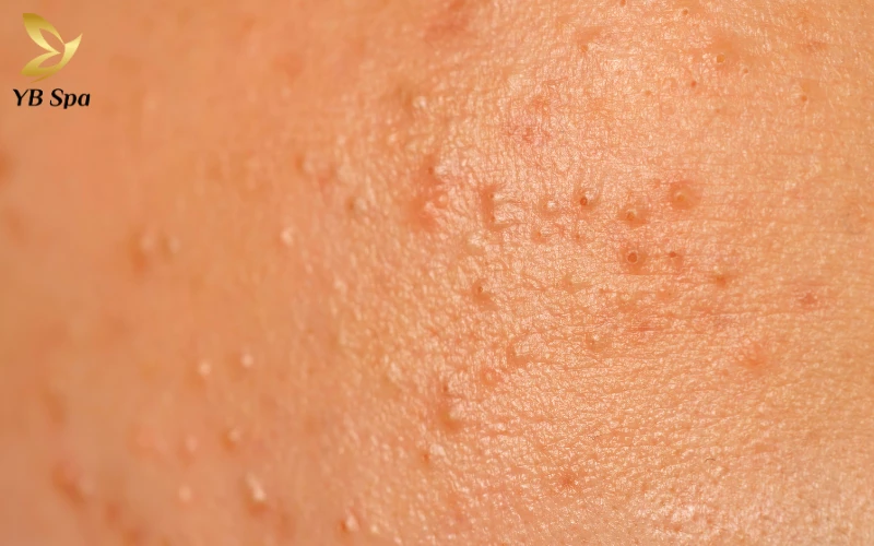 Da mặt đột nhiên nổi nhiều mụn - Nguyên nhân và giải pháp điều trị 31 Mụn nội tiết