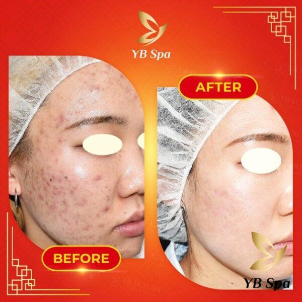 da mụn có tiêm meso được không