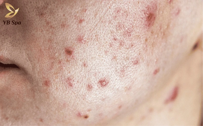 Tìm hiểu mức độ an toàn và hiệu quả của phương pháp meso đối với da mụn qua góc nhìn chuyên môn từ YB Spa
