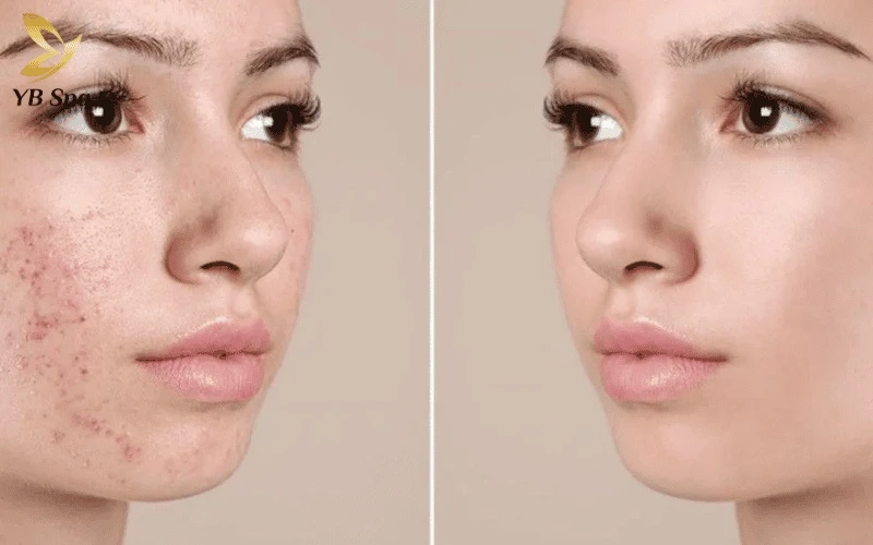 Đối với mụn viêm nhẹ, tiêm các hoạt chất kháng viêm qua meso giúp giảm sưng nhanh chóng và hạn chế tổn thương mô