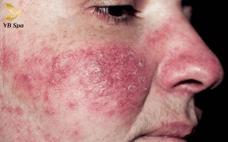 Tuyệt đối không thực hiện tiêm meso trên nền da đang nhiễm trùng hoặc nhiễm nấm để tránh các biến chứng u hạt nghiêm trọng