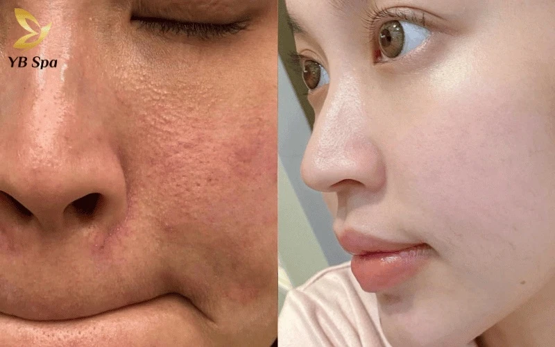 Hiệu quả thực tế chứng minh meso là "chìa khóa" giúp dứt điểm mụn và tái tạo da tầng sâu tại YB Spa