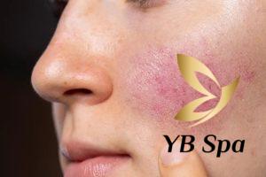 meso có thể là một trong những phương pháp điều trị hiệu quả đối với Da nhiễm Corticoid