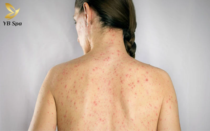 Da nổi chấm đỏ như nốt ruồi son không ngứa là gì? Có đáng lo ngại không?