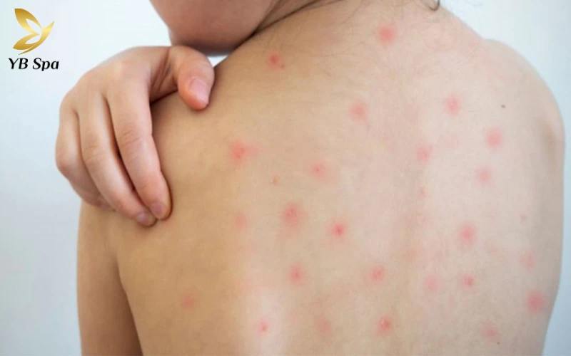 Đặc điểm nhận biết da nổi chấm đỏ như nốt ruồi son không ngứa