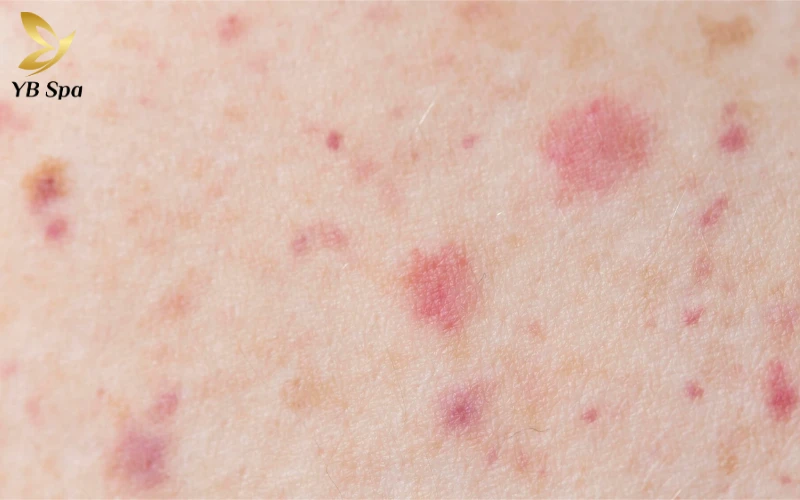 Viêm mao mạch dị ứng