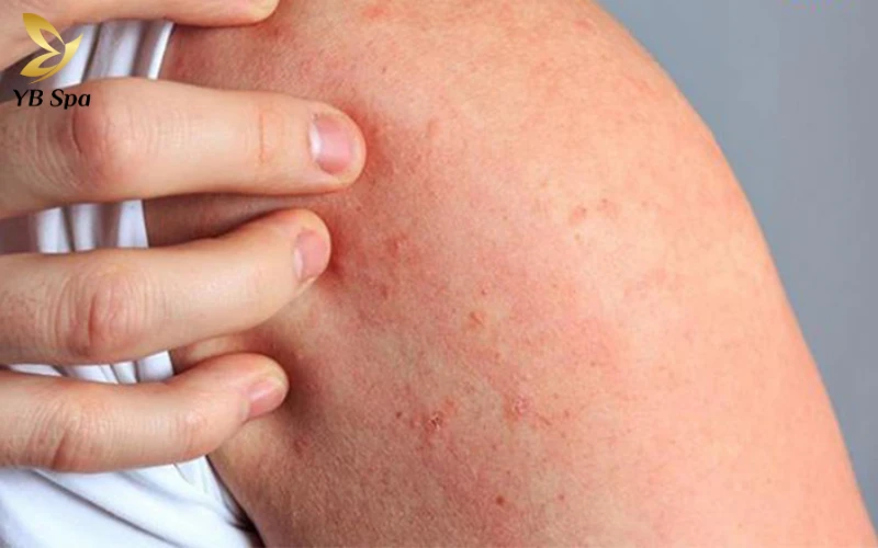 Da nổi chấm đỏ như nốt ruồi son không ngứa có nguy hiểm không?