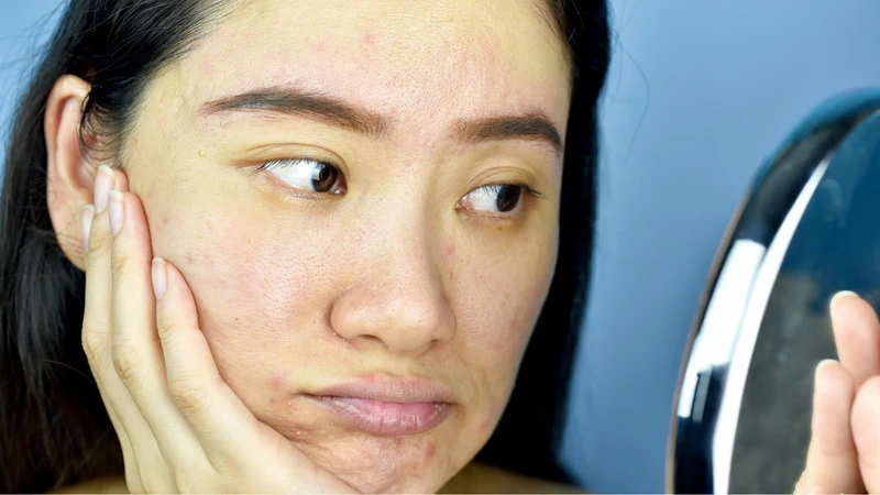 Da sần sùi mụn ẩn: Nguyên nhân, cách điều trị da mặt sần sùi