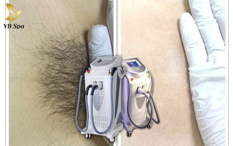 Đàn ông có thích phụ nữ triệt lông vùng kín không? 14 YB Spa tiên phong ứng dụng Nano Diamond Light, giải pháp triệt lông thông minh kết hợp giữa tính an toàn và hiệu quả thẩm mỹ vượt trội