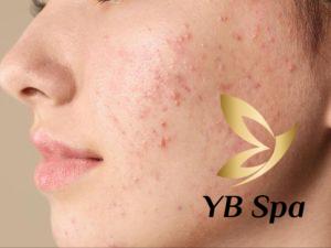 Đẩy mụn là gì? Lợi ích của việc đẩy mụn là gì?