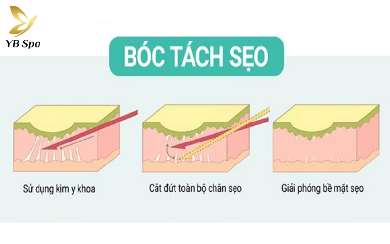 Công nghệ Density trị sẹo rỗ có đúng không? 29 Bóc tách đáy sẹo (Subcision)