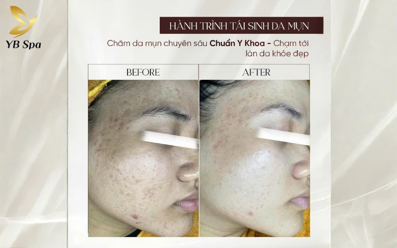 Tổng quan về chi phí nặn mụn tại spa