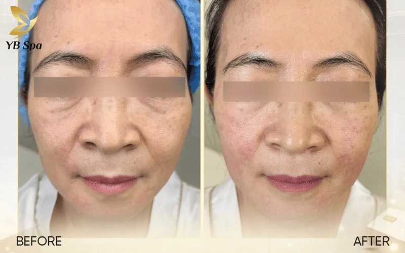 5 Địa Chỉ Trẻ Hoá Da Tại Tphcm Không Thể Bỏ Lỡ Của Phái Đẹp 10 Trải nghiệm làm đẹp tại YB Spa ghi điểm tuyệt đối nhờ sự kết hợp giữa công nghệ hiện đại và dịch vụ chăm sóc khách hàng tận tâm, chuyên nghiệp