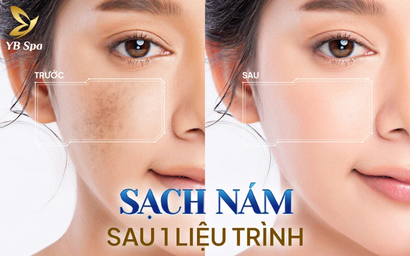 địa chỉ trị nám uy tín tại TP.HCM