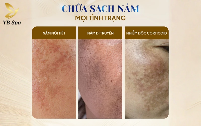 YB Spa - Địa chỉ trị nám uy tín