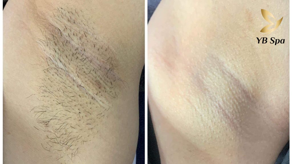 Yếu tố giúp YB Spa trở thành địa chỉ triệt lông số 1 sài gòn hiện nay 19 Dia Chi Triet Long So 1 Sai Gon 2