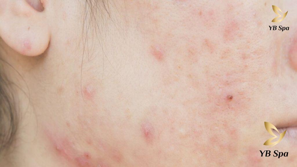 Điều trị mụn trứng cá hiệu quả 21 Dieu Tri Mun Trung Ca 1