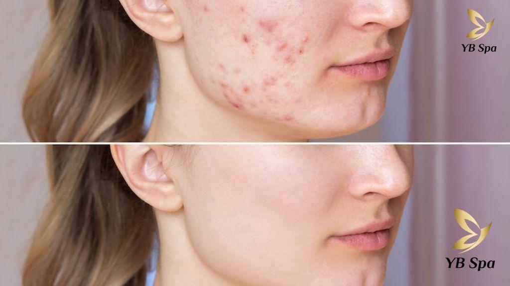 Điều trị mụn trứng cá hiệu quả 26 Dieu Tri Mun Trung Ca 6