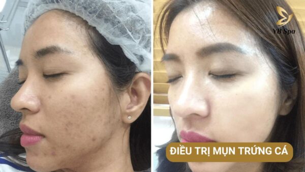 dieu tri mun trung ca