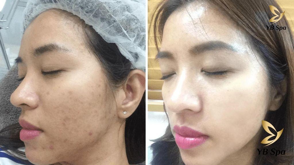 Điều trị mụn trứng cá hiệu quả 27 Dieu Tri Mun Trung Ca 7