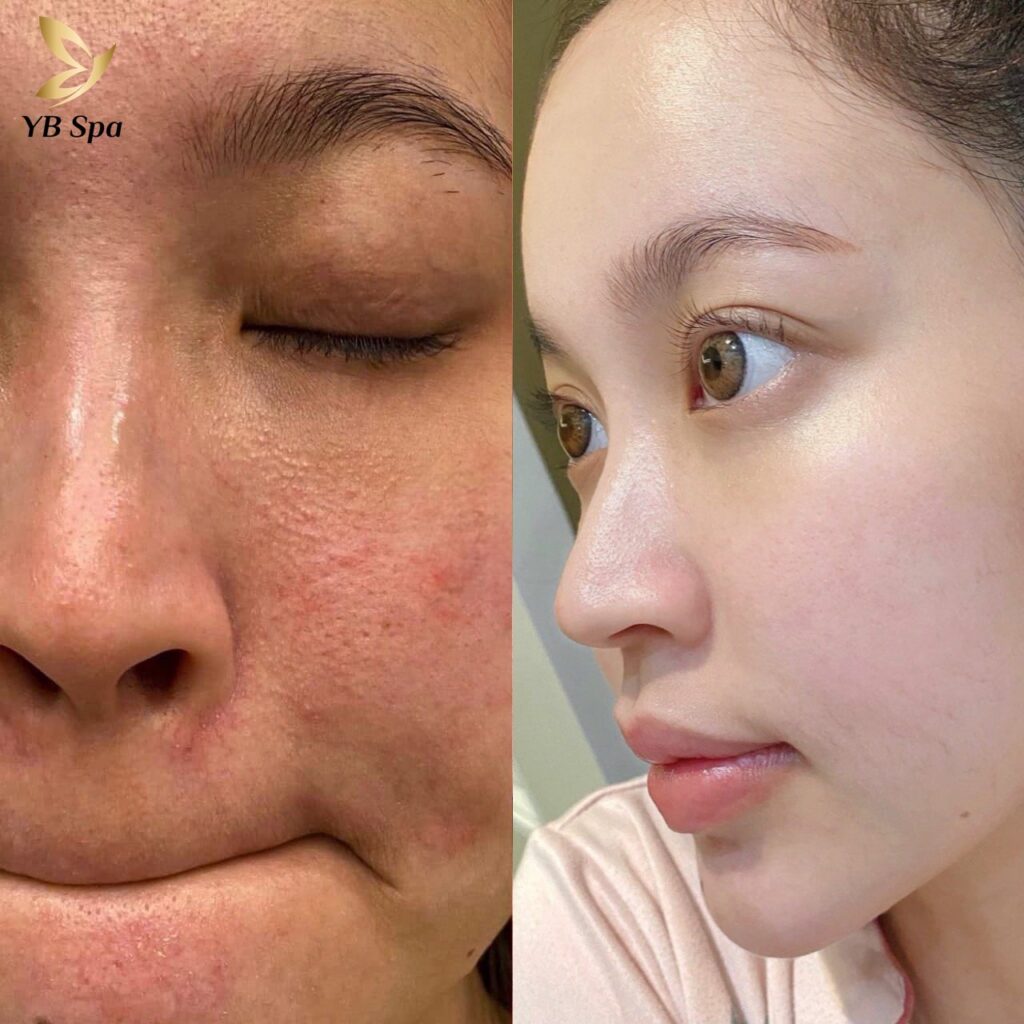 CHRISTINA COMODEX – Phương pháp điều trị mụn thế hệ mới