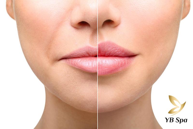 Cẩn trọng với những biến chứng filler rởm