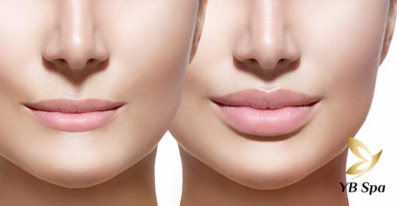 Cẩn trọng với những biến chứng filler rởm