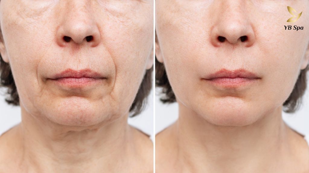 Phân biệt filler và botox: Xu hướng làm đẹp thịnh hành  23 Filler Va Botox 4