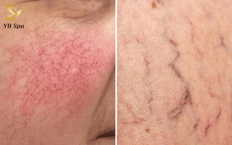 Chi phí điều trị được xác định dựa trên kích thước và màu sắc mao mạch để đảm bảo phác đồ Laser Chrome hiệu quả nhất