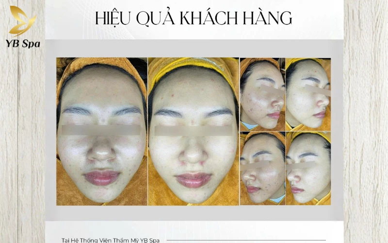 Hiệu quả khách hàng chăm sóc da mặt trước sau