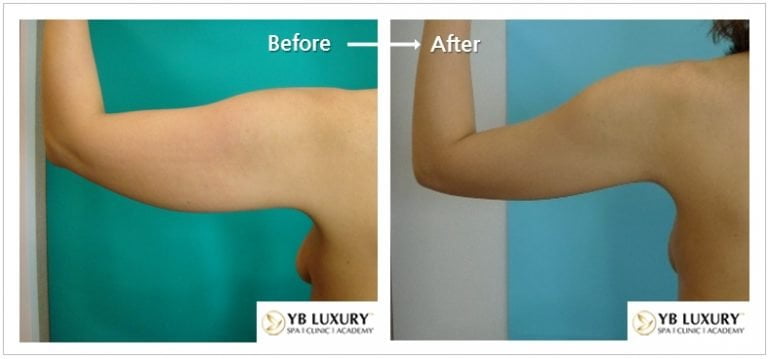 Phương pháp giảm mỡ bắp tay HIỆU QUẢ bằng công nghệ hiện đại 25 Giam Mo Duoi Bap Tay 768x359
