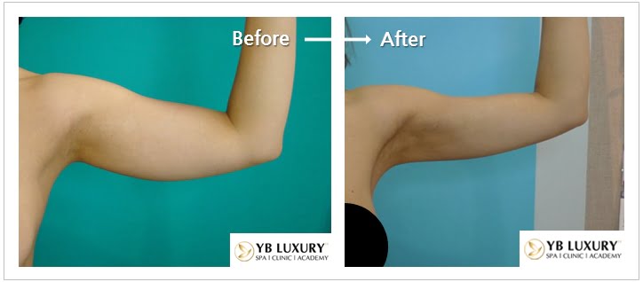 Phương pháp giảm mỡ bắp tay HIỆU QUẢ bằng công nghệ hiện đại 24 Giam Mo O Bap Tay