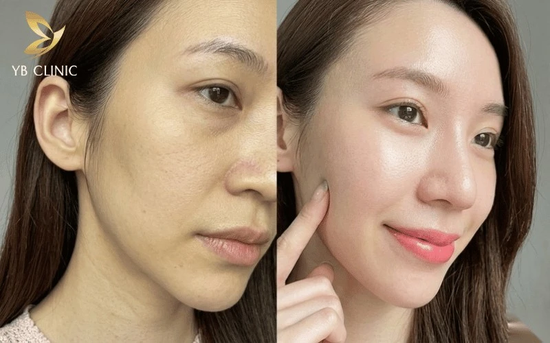 Làn da tích tụ độc tố AGEs bị sạm vàng, xỉn màu và thiếu sức sống rõ rệt.