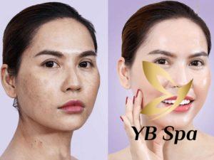 Phương pháp meso đã được FDA Hoa Kỳ chứng nhận về độ an toàn và tính hiệu quả vượt trội.