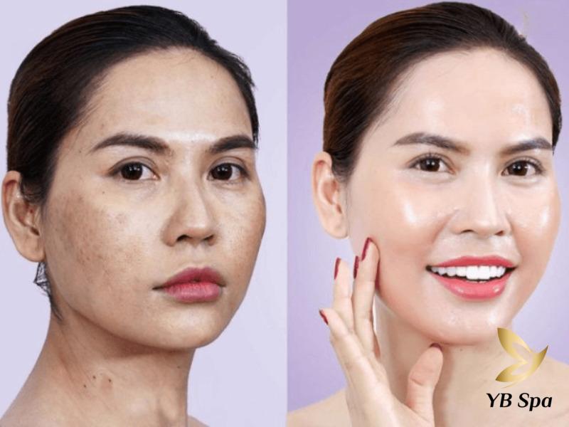 Hướng dẫn cách Meso đúng chuẩn an toàn và hiệu quả 5 Phương pháp meso đã được FDA Hoa Kỳ chứng nhận về độ an toàn và tính hiệu quả vượt trội.