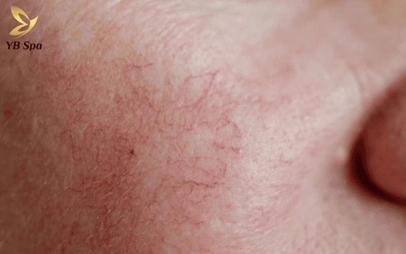 Mạch máu đỏ tươi xuất hiện sát bề mặt biểu bì là dấu hiệu điển hình của làn da bị bào mỏng do tia UV hoặc Corticoid