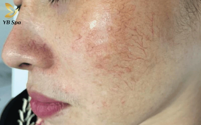 Tình trạng mạch máu giãn nở thường biểu hiện dưới dạng các đường kẻ xanh, tím nổi bật ở những vùng da mỏng hoặc chịu áp lực lớn