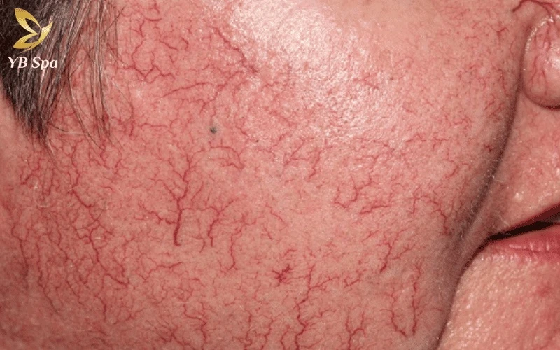 Những mạch máu tồn tại nhiều năm thường nhô nhẹ trên bề mặt da và mất đi khả năng đàn hồi vốn có