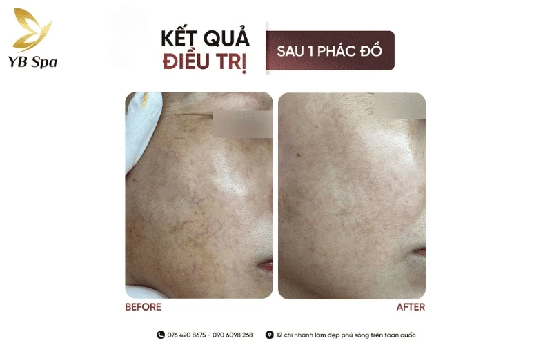 Cận cảnh bước xóa sổ các vết mạng nhện máu li ti bằng xung laser chuẩn y khoa, giúp trả lại làn da sáng mịn cho khách hàng