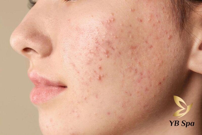 Top 5 kem gom cồi mụn hiệu quả nhất hiện nay 22 Kem gom cồi mụn được ưa chuộng bởi khả năng đặc trị mụn từ sâu bên trong (Nguồn: Internet)